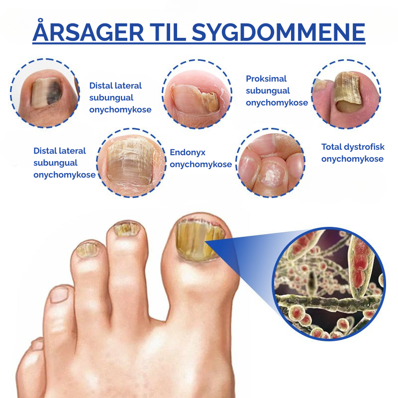 NailedIt™ | Apparat til laserbehandling af neglesvamp